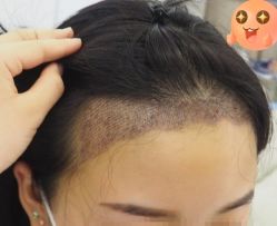 -大麦微针植发丨全国连锁