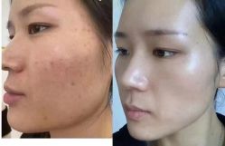 -瑶芳清颜草本祛痘