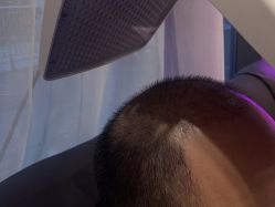 -碧莲盛·不剃发植发