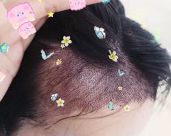 -大麦微针植发全国连锁