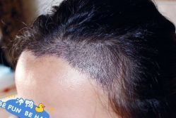 -大麦微针植发丨全国连锁