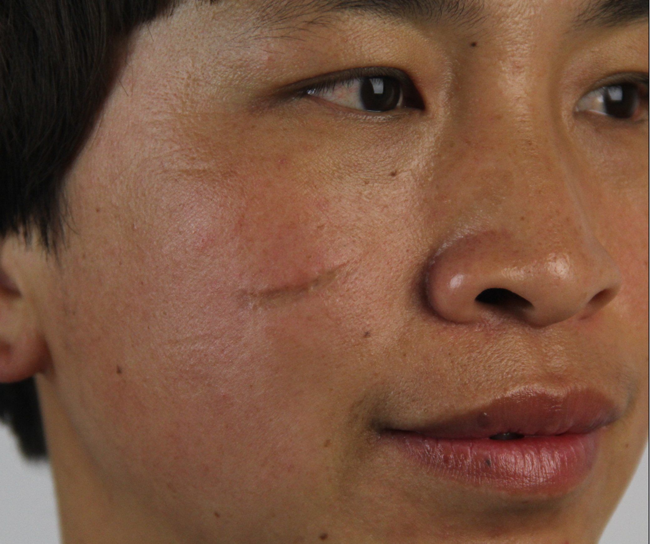 脸上有个小疤痕,有时候明显有时候不明显,朋友家人都说没必要修复