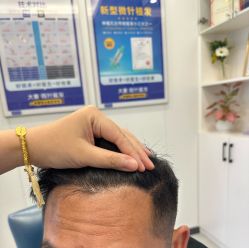 -大麦微针植发全国连锁