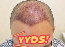 -大麦微针植发丨全国连锁