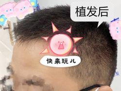 -大麦微针植发全国连锁