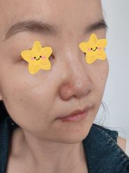 体验后-SOS修丽可.痘肌修复中心