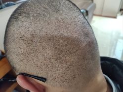 -碧莲盛·不剃发植发