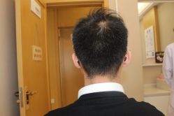 -大麦微针植发丨全国连锁