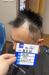 -大麦微针植发全国连锁