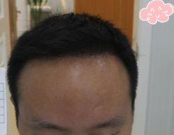 -大麦微针植发丨全国连锁