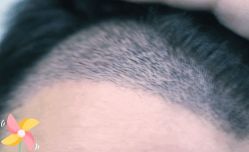 -大麦微针植发丨全国连锁