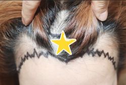 -大麦微针植发全国连锁