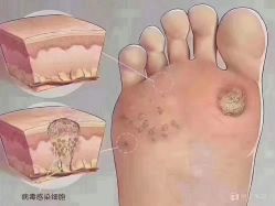 -德哥灰指甲脚气甲沟炎跖疣护理