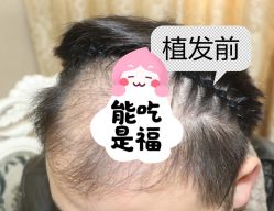 -大麦微针植发全国连锁