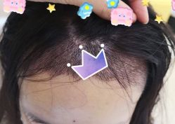 -大麦微针植发全国连锁