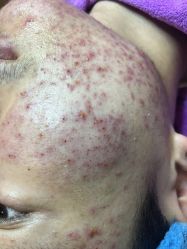 -蕾特恩祛痘•皮肤管理