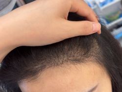 -大麦微针植发全国连锁