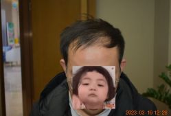 体验前-大麦微针植发全国连锁