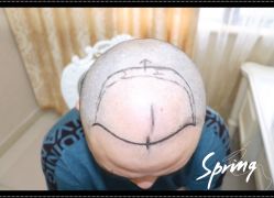 点击看大图 体验后-大麦微针植发全国连锁