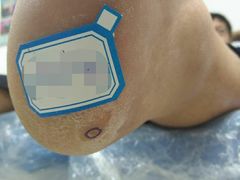 -朋朋修脚·灰指甲·甲沟炎·跖疣(人民路店)
