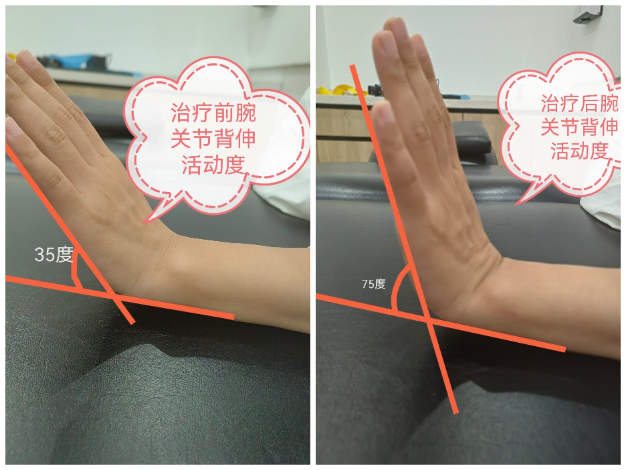 腕关节背伸,几个动作可以纠正!