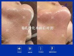 点击看大图 -靓芙泉专研痘痘肌