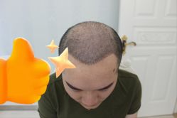 -大麦微针植发丨全国连锁