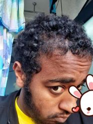 -大麦微针植发丨全国连锁