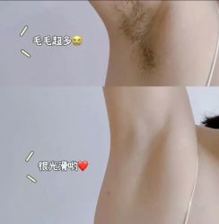 -薇兰专业脱毛连锁机构