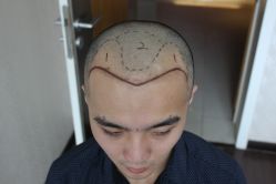 点击看大图 -大麦微针植发丨全国连锁