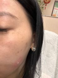 体验后-北京美痣堂古方祛痣斑疣瘊
