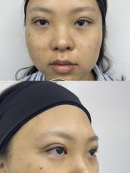 -广州健丽·去眼袋医疗美容机构