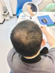 -大麦微针植发全国连锁