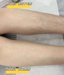 -薇兰专业脱毛连锁机构