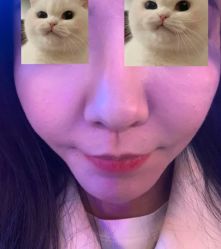 体验后-洁铭新加坡医美