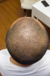 体验后-大麦微针植发全国连锁