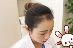 点击看大图 -大麦微针植发丨全国连锁