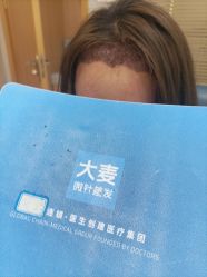 -大麦微针植发丨全国连锁