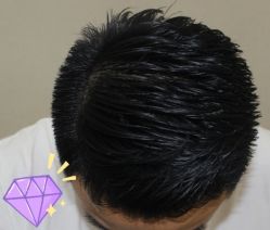 -大麦微针植发丨全国连锁