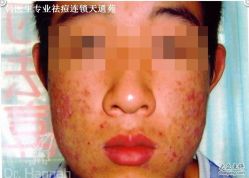 -韩医生专业祛痘连锁机构