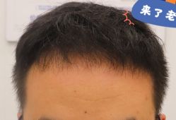 -大麦微针植发全国连锁