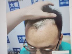 体验前-大麦微针植发丨全国连锁