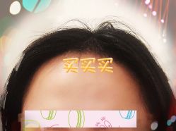 -大麦微针植发全国连锁