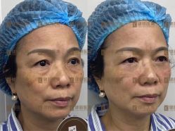 -广州健丽·去眼袋医疗美容机构