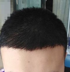 -大麦微针植发丨全国连锁