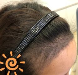 -大麦微针植发丨全国连锁