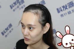 点击看大图 -大麦微针植发丨全国连锁