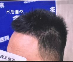 -北京雍禾植发医院