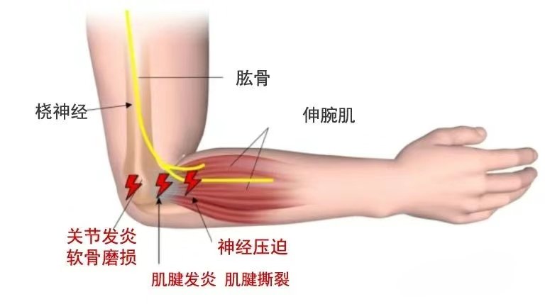 肱骨外上髁肌肉图片