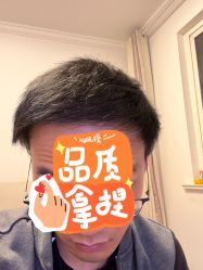 -大麦微针植发丨全国连锁